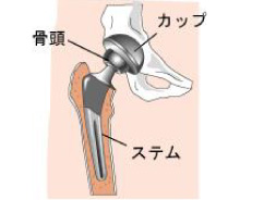 人工股関節の構造、摩耗を少なくし、長寿命化を目指す